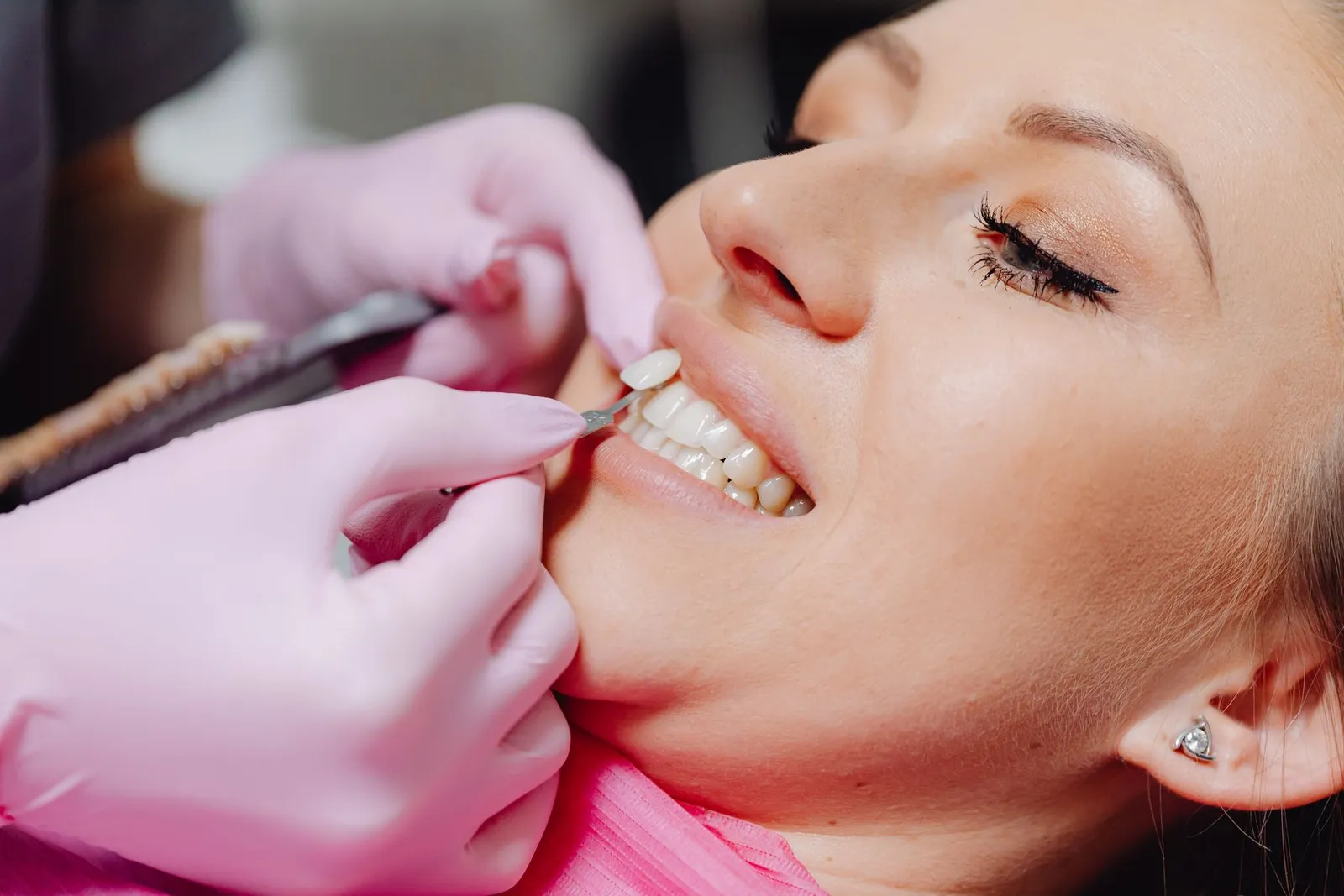 Prueba de color de una carilla junto a los dientes de una paciente