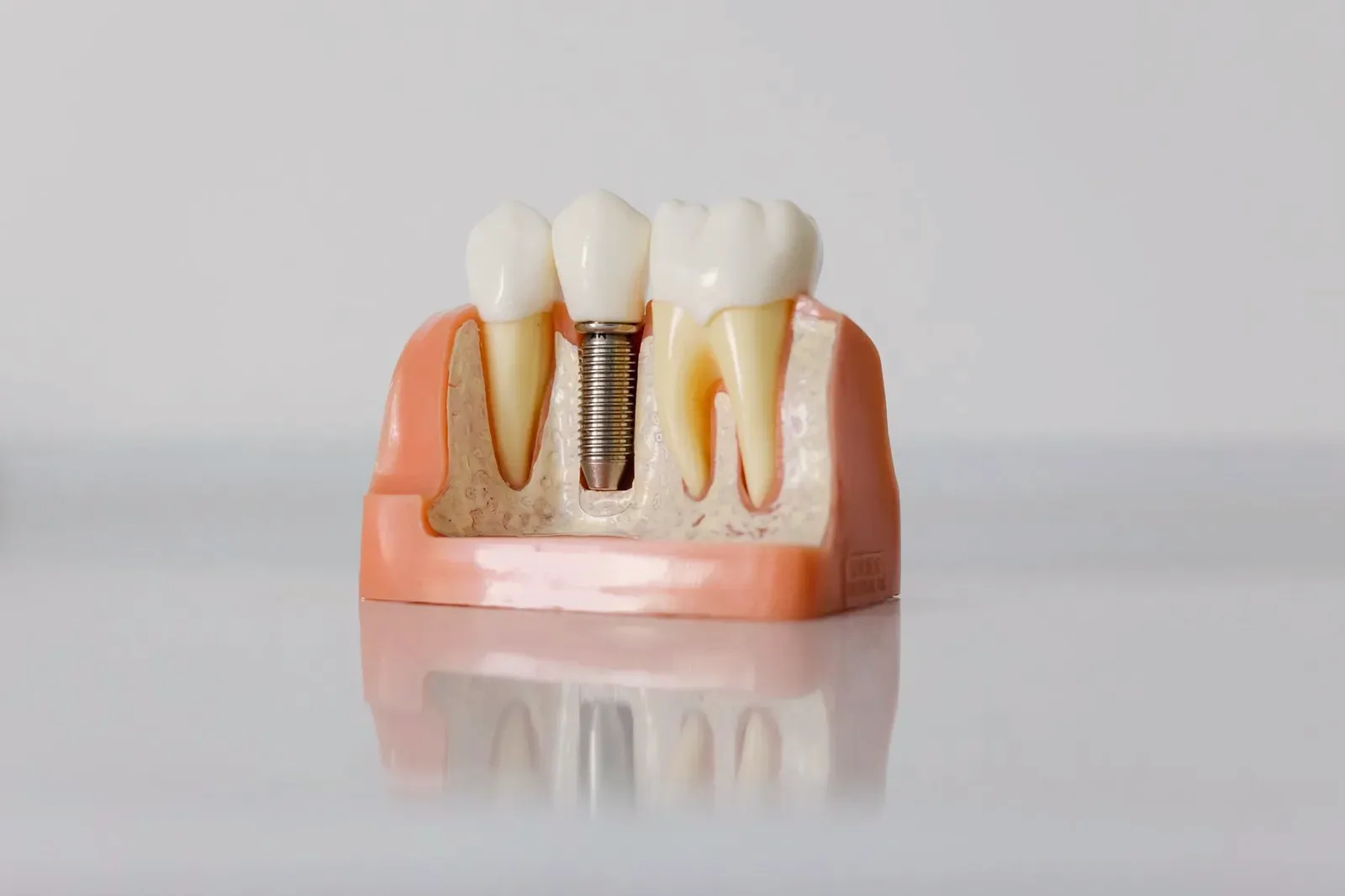 Modelo de implante dental con el tornillo de titanio a la vista